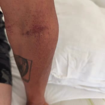 Veet Tüy Dökücü Krem Cildimi Tahriş Etti, Paramı Geri İstiyorum!