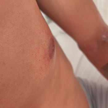 Veet Tüy Dökücü Krem Cildimi Tahriş Etti, Paramı Geri İstiyorum!