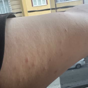 Veet Tüy Dökücü Krem Cildimi Tahriş Etti, Paramı Geri İstiyorum!