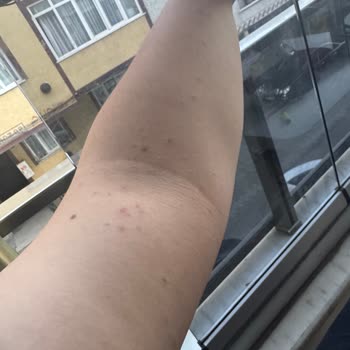 Veet Tüy Dökücü Krem Cildimi Tahriş Etti, Paramı Geri İstiyorum!