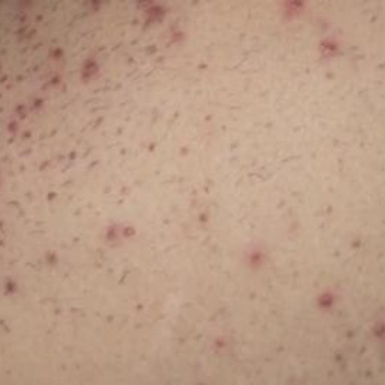 Veet Tüy Dökücü Krem Cildimi Tahriş Etti, Paramı Geri İstiyorum!