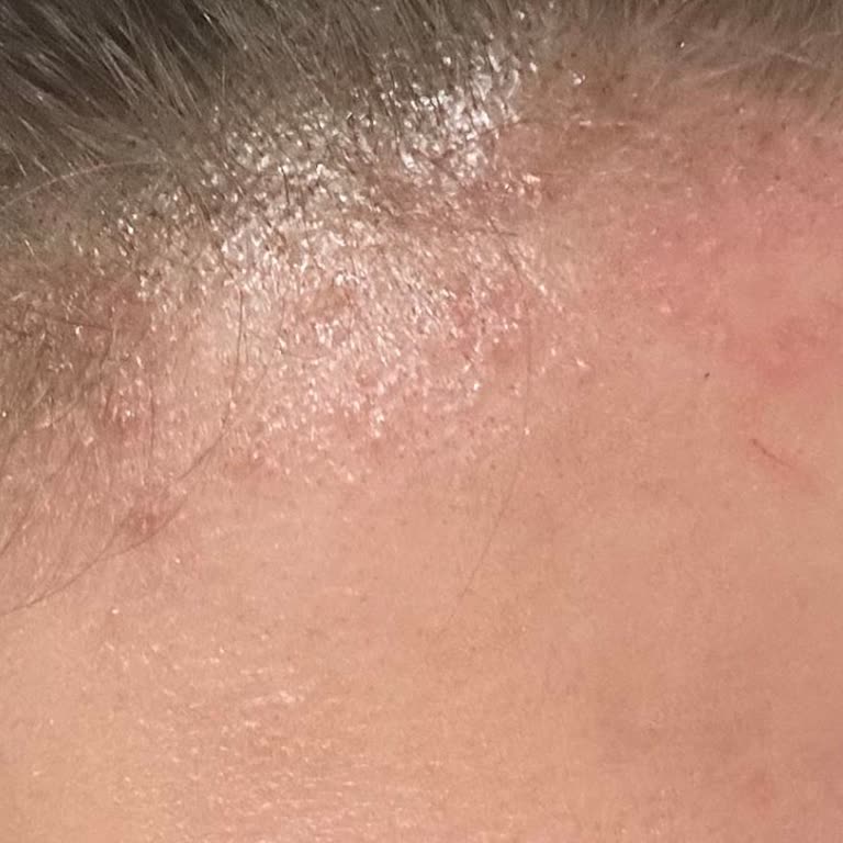 Saç Rengim Ve Sağlığım Salon Hatalarıyla Mahvoldu