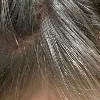 Saç Boyası Sonrası Kaşıntı Yara Ve Saç Kopması Yaşadım