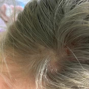 Saç Boyası Sonrası Kaşıntı Yara Ve Saç Kopması Yaşadım