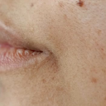 Yanlış Uygulama Sonrası Kalıcı Leke Ve İlgisiz, Kaba Yaklaşım Mağduriyeti