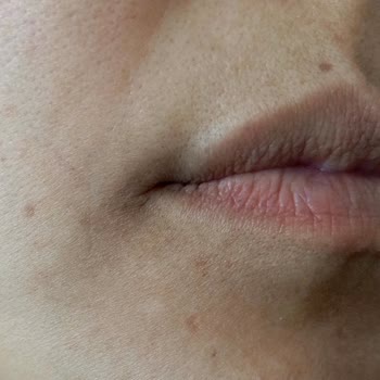 Yanlış Uygulama Sonrası Kalıcı Leke Ve İlgisiz, Kaba Yaklaşım Mağduriyeti