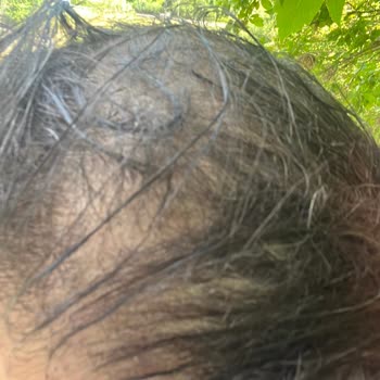 Saç Ekimi Sırasında İzinsiz Saç Kesimi Ve Acı Veren İşlem