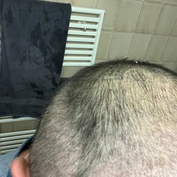 Saç Ekimi Sırasında İzinsiz Saç Kesimi Ve Acı Veren İşlem