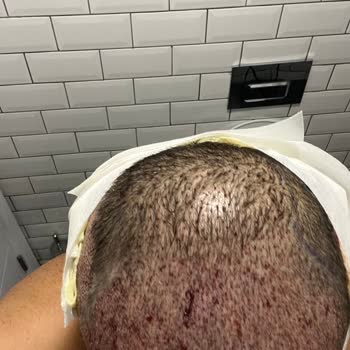 Saç Ekimi Sırasında İzinsiz Saç Kesimi Ve Acı Veren İşlem