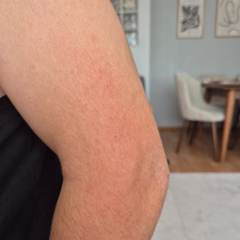 Bioderma Güneş Kremi Ciltte Alerjik Reaksiyona Sebep Oldu, İade Edilmiyor