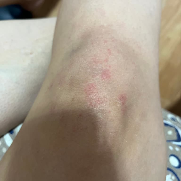 Epilasyon Sonrası Yanık Ve İlgisizlik Mağduriyeti