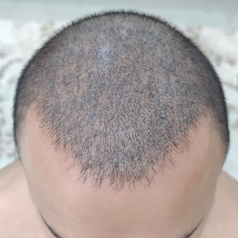 Yanlış Uygulama Sonucu Kafa Derimde Dövme Oluştu