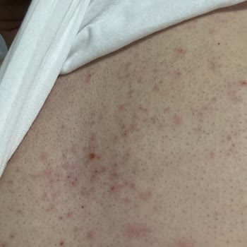 Tüy Dökücü Sprey Cildimde Alerji Yaptı, Mağdur Oldum