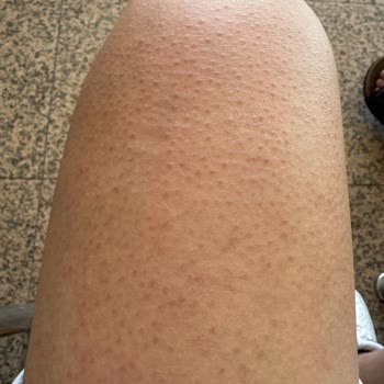 Tüy Dökücü Sprey Cildimde Alerji Yaptı, Mağdur Oldum