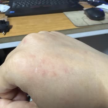 Sivrisinek Kovucu Sonrası Ciltte Kaşıntı Ve Kızarıklık Sorunu