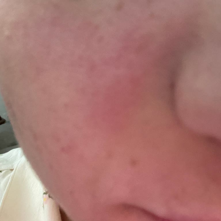 Eyüp Sabri Tuncer Gül Suyu Kullanımı Sonrası Yüzde Yanma Ve Kızarıklık Oluştu