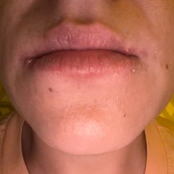 Diş Macunu Kullanımı Sonrası Şiddetli Ağız Yaraları Ve Sağlık Problemleri