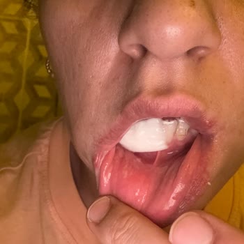 Diş Macunu Kullanımı Sonrası Şiddetli Ağız Yaraları Ve Sağlık Problemleri