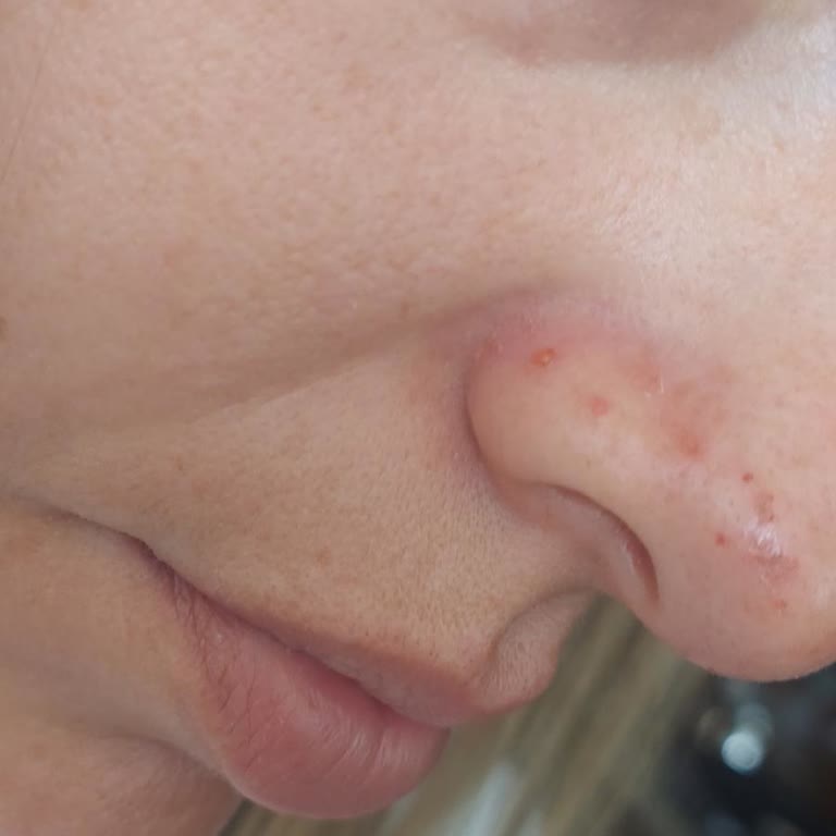 Kore Cilt Bakımı Adı Altında Yanlış Ve Zararlı İşlem Uygulandı