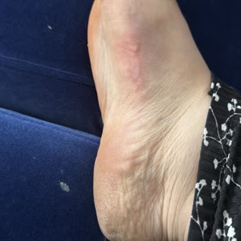 Satın Aldığım Terlik Ayağımı Yara Yaptı İade Talebim Reddedildi