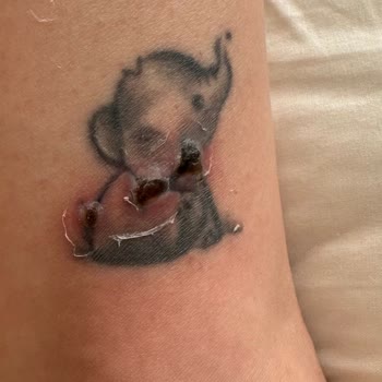 Lazer Epilasyon Sonrası Dövmem Yandı, Para İadem Yapılmadı!