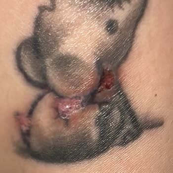 Lazer Epilasyon Sonrası Dövmem Yandı, Para İadem Yapılmadı!