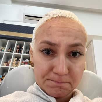 Yanlış Renk Saç Boyası Nedeniyle Sağlık Ve Maddi Mağduriyet