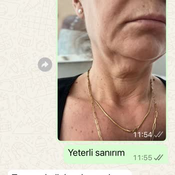 Hifu İşlemi Sonrası Gıdı Bölgemde Artış Yaşadım Sonuç Alamadım