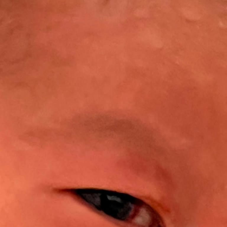 Sezaryen Sonrası Bebeğimin Başında Yara Ve Gözünde Kanlanma Oluştu