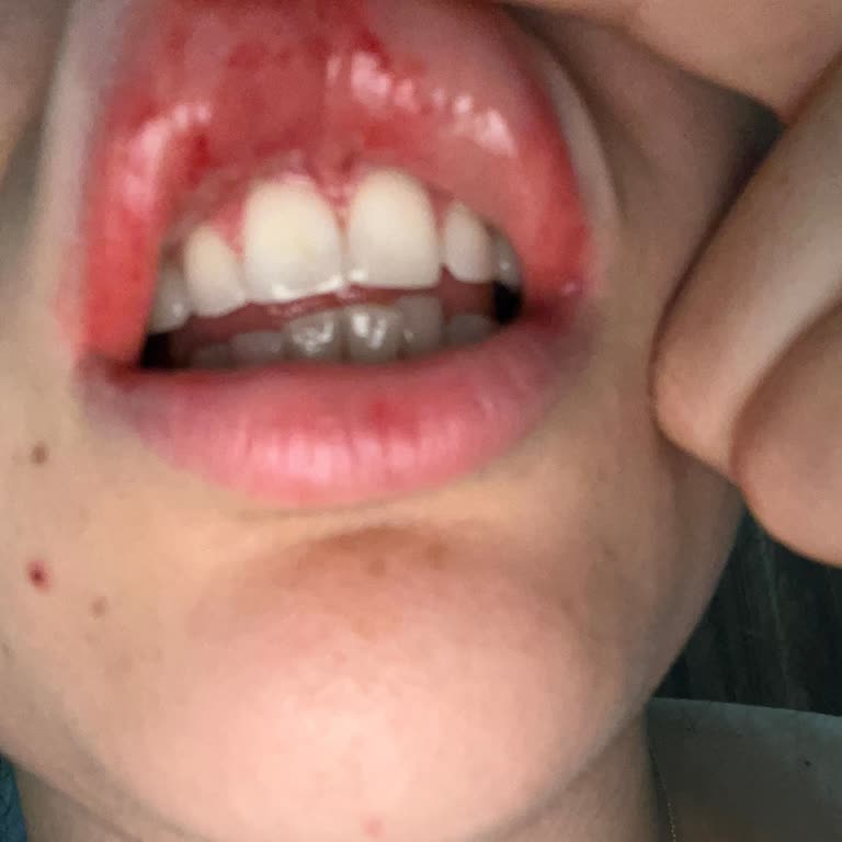 I Experience Severe Mouth Irritation with Parodontax Gum Sensitivity Toothpaste