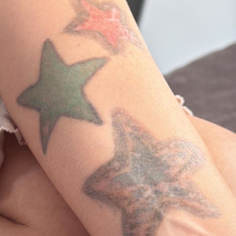 Pera Güzellik Merkezi Dövme Silme İşlemi Başarısız Oldu