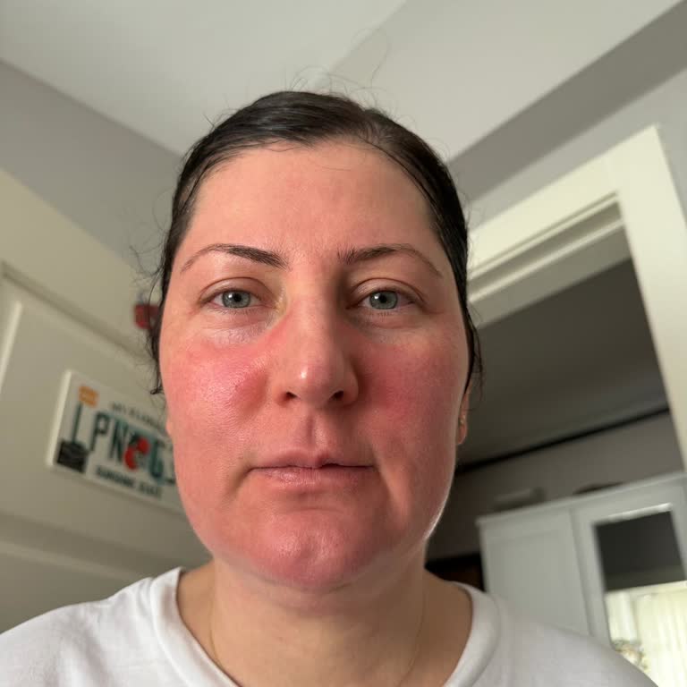 Güneş Kremi Yüzümde Şişlik Ve Yanma Yaptı