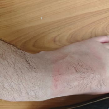 Muya Terlik Ayağımı Mahvetti Tatilim Rezil Oldu