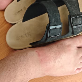 Muya Terlik Ayağımı Mahvetti Tatilim Rezil Oldu