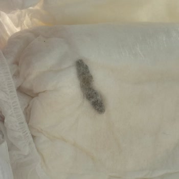 Çocuk Bezinden Çıkan Yabancı Madde Şoku