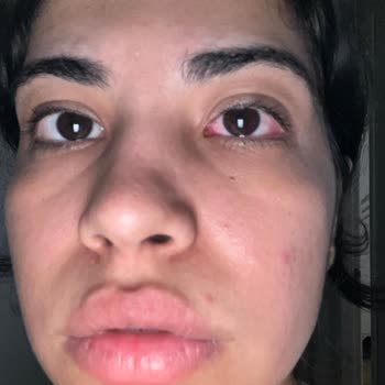 Bulaşık Tableti Patladı, Gözüm Zarar Gördü Sağlık Riski Yaşadım