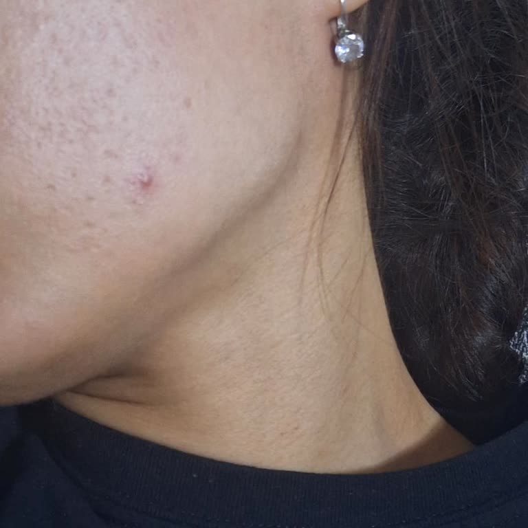 Korendy Aldığım Tonikler Cildimde Ciddi Akne Ve Komedonlara Yol Açtı