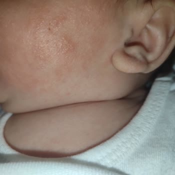 Bebeğimde Mustela Ürünleri Sonrası Ciddi Cilt Sorunları Yaşadık