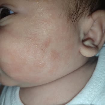 Bebeğimde Mustela Ürünleri Sonrası Ciddi Cilt Sorunları Yaşadık