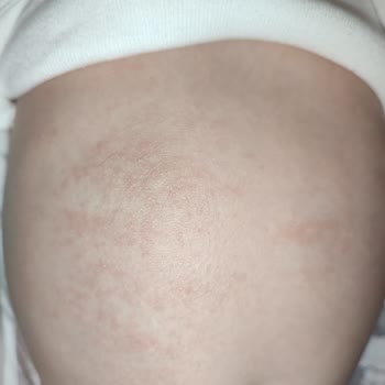 Bebeğimde Mustela Ürünleri Sonrası Ciddi Cilt Sorunları Yaşadık