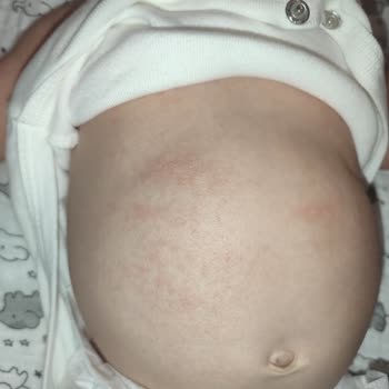 Bebeğimde Mustela Ürünleri Sonrası Ciddi Cilt Sorunları Yaşadık