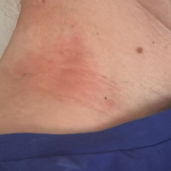 Beklentileri Karşılamayan Ürün Kalitesi Ve Alerjik Reaksiyon