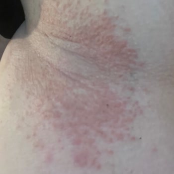 Cilt Bakım Ürünü Ciddi Alerjik Reaksiyona Neden Oldu