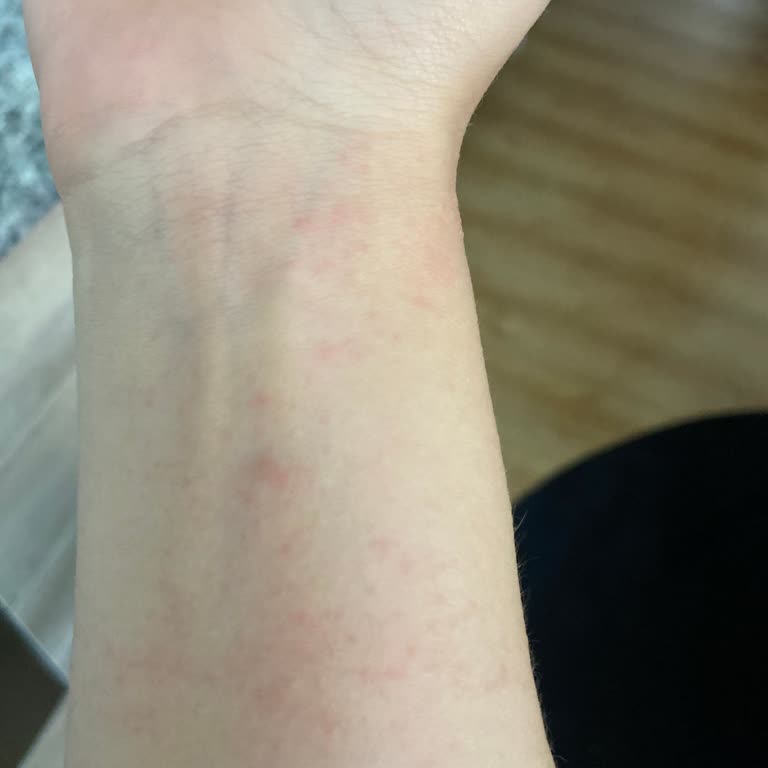 Alerji Yapan Ürün Sonrası Değişim Hakkı Verilmedi