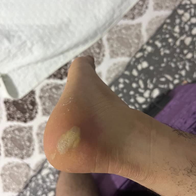 Reebok Ayakkabı Ayağımı Yaraladı, İnceleme Sonucu Mağdur Etti