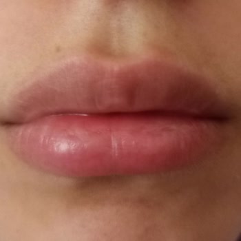 Yanlış Uygulanan Dudak Dolgusu Hayal Kırıklığına Uğrattı