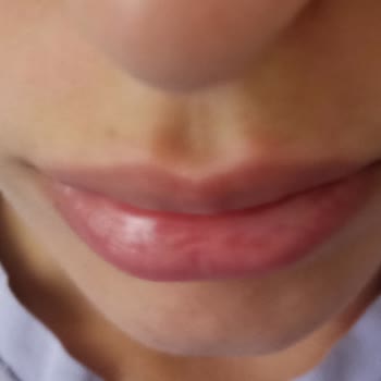 Yanlış Uygulanan Dudak Dolgusu Hayal Kırıklığına Uğrattı