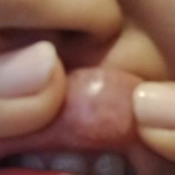 Yanlış Uygulanan Dudak Dolgusu Hayal Kırıklığına Uğrattı