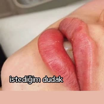 Yanlış Uygulanan Dudak Dolgusu Hayal Kırıklığına Uğrattı