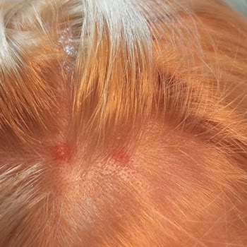 Palette Saç Boyası Saç Derimde Yanma Ve Su Toplamasına Neden Oldu